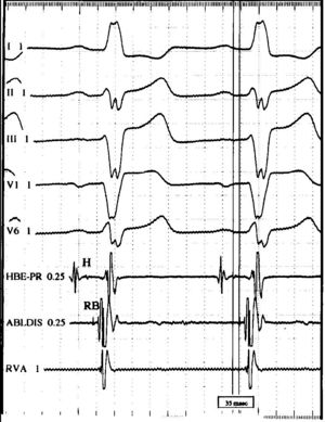 His Bundle activation prior to Ventricular activation