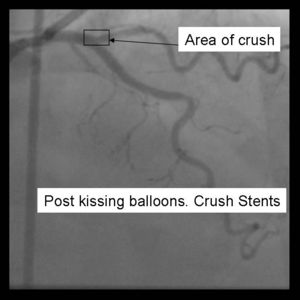 Crush Stenting Step 8