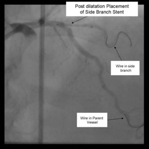 Crush Stenting Step 1
