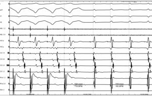The Post Pacing Interval is 508 ms and the Tachycardia Cycle Length is 328 ms. So the PPI-TCL equals 180 ms supporting evidence for AVNRT