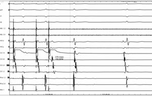 AH interval Jumps to 376 ms at Drive train of 400ms when the S2 is decreased by 10 ms. This figure shows the jump with a single echo beat