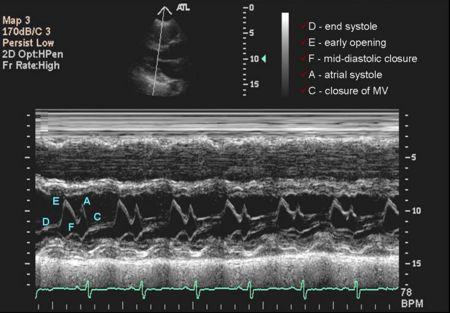 Mitral M-Mode