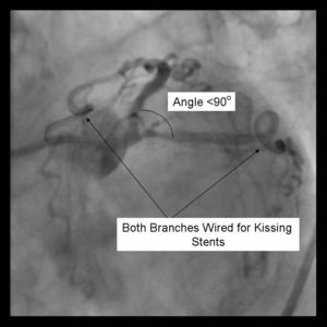Kissing Stents