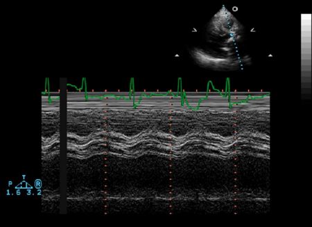Aortic Stenosis M Mode