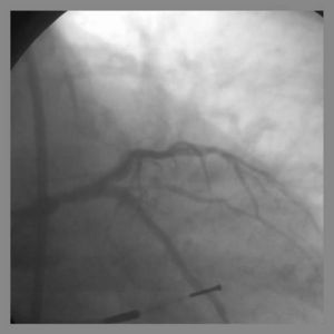 T Stenting