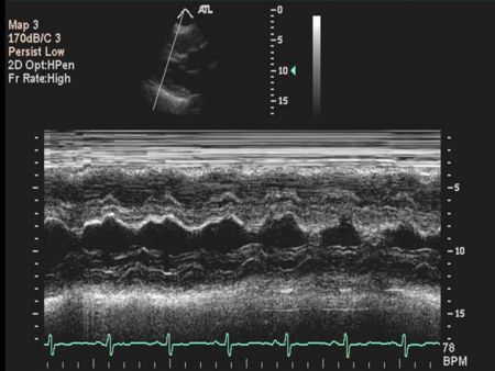 Ventricular M-Mode