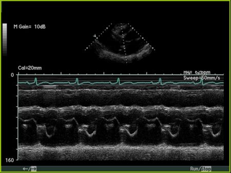 Flail Posterior Mitral Leaflet  M Mode