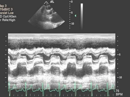 Mitral Stenosis M Mode