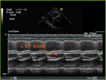 Mitral Stenosis M Mode
