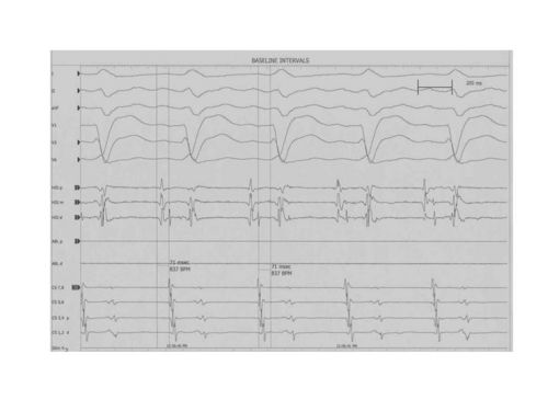 This patient presented to the hospital with a wide complex tachycardia with the same morphology as the baseline sinus rhythm EKG. Measurement of baseline intervals revealed a prolonged HV interval.