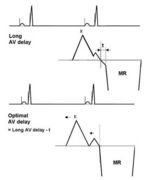 Simplified Mitral Inflow Method