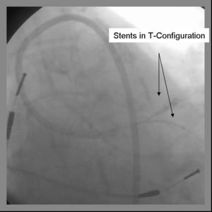 T Stenting