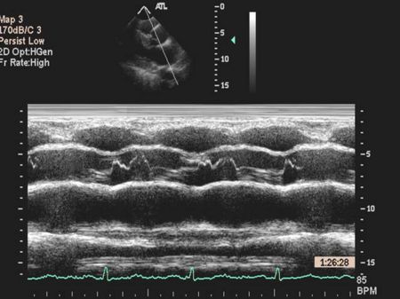 HOCM Mid Systolic AV Closure