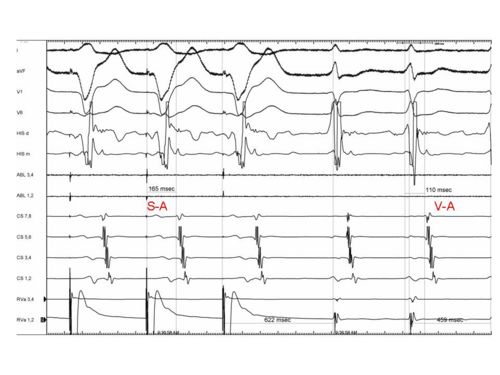 In the above example the Stimulus to A is 165 ms and the V to A is 110 ms. Thus the SA- VA equals 55 ms providing evidence that there is a septal pathway