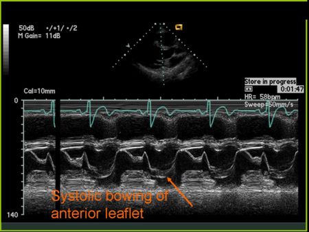 MItral Valve Prolapse.jpg M Mode