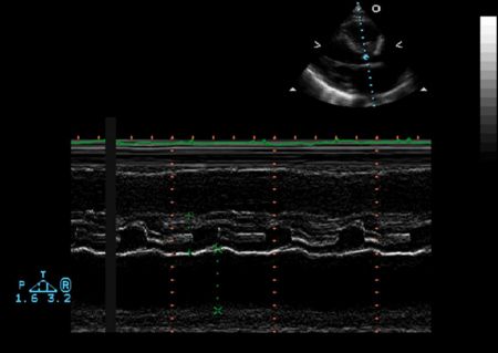 Aortic Valve Endocarditis M Mode