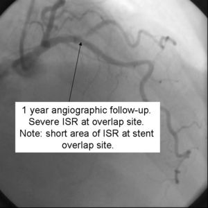 Crush Stenting Step 9